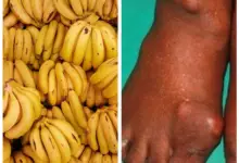 Are Bananas Good For Gout