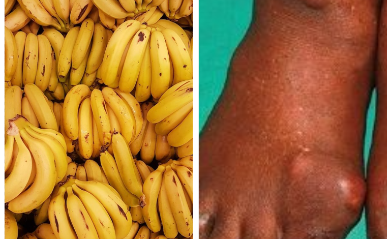 Are Bananas Good For Gout