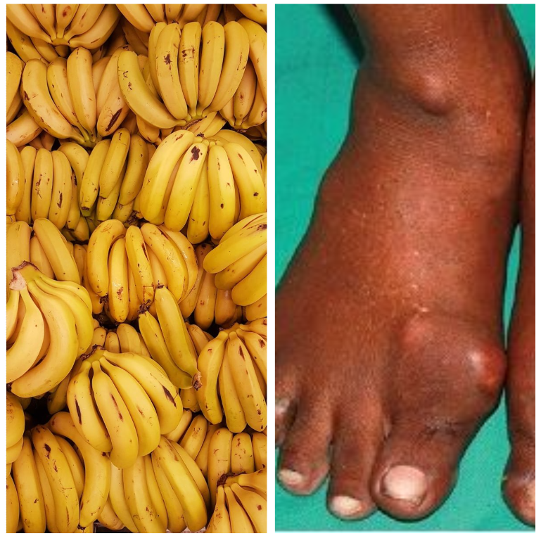 Are Bananas Good For Gout