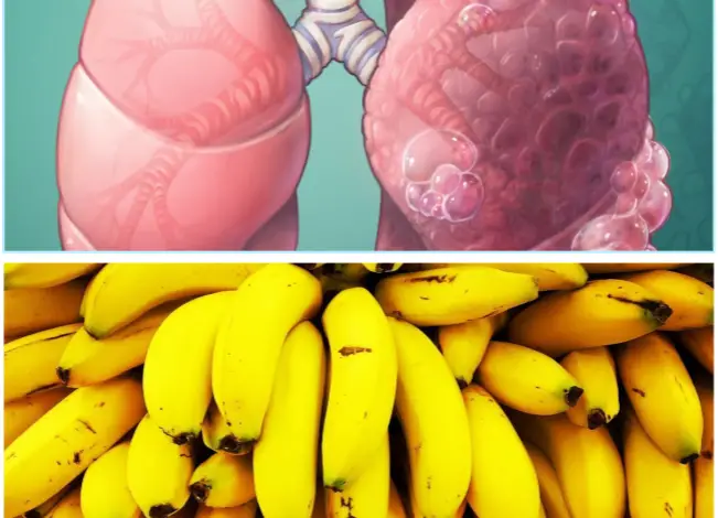 Are Bananas Good for COPD Patients?