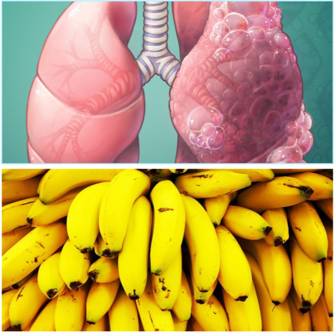 Are Bananas Good for COPD Patients?