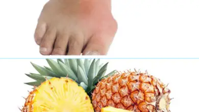 Is Pineapple Good or Bad for Gout