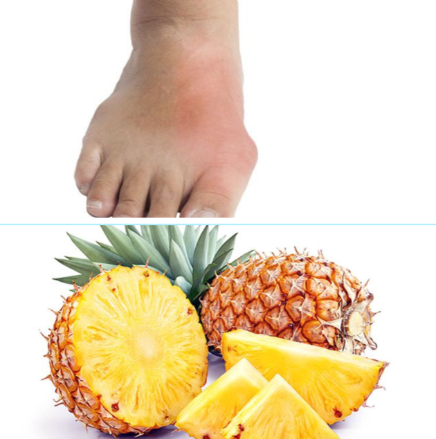 Is Pineapple Good or Bad for Gout